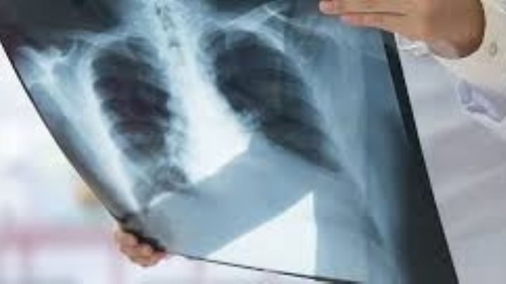 El de pulmón, es la principal causa de muerte por cáncer en Argentina