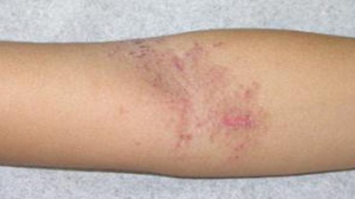 Campaña de turnos gratuitos para diagnosticar la dermatitis atópica