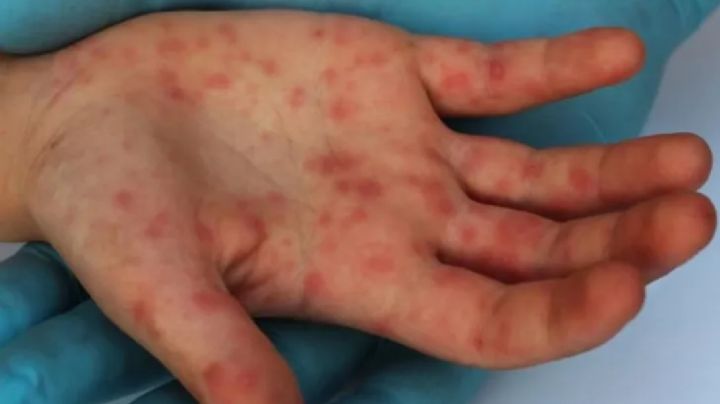 Informaron un "posible caso" de sarampión en CABA y emiten alerta epidemiológico