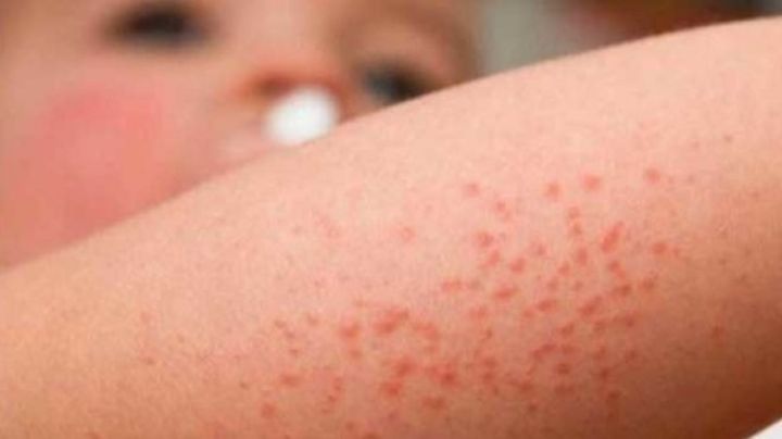 Algunas de las consecuencias más graves de la dermatitis atópica