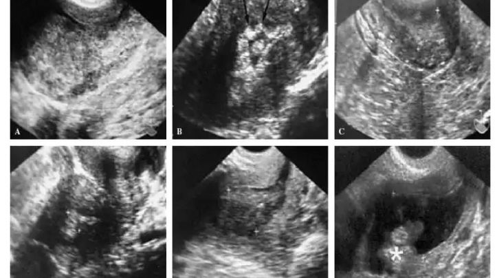 Llega a la Argentina una nueva terapia para pacientes con cáncer de endometrio